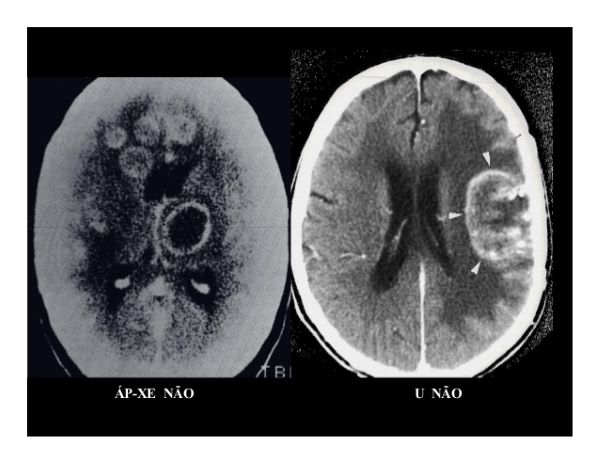 Hình ảnh chụp cộng hưởng từ MRI áp xe não và u não